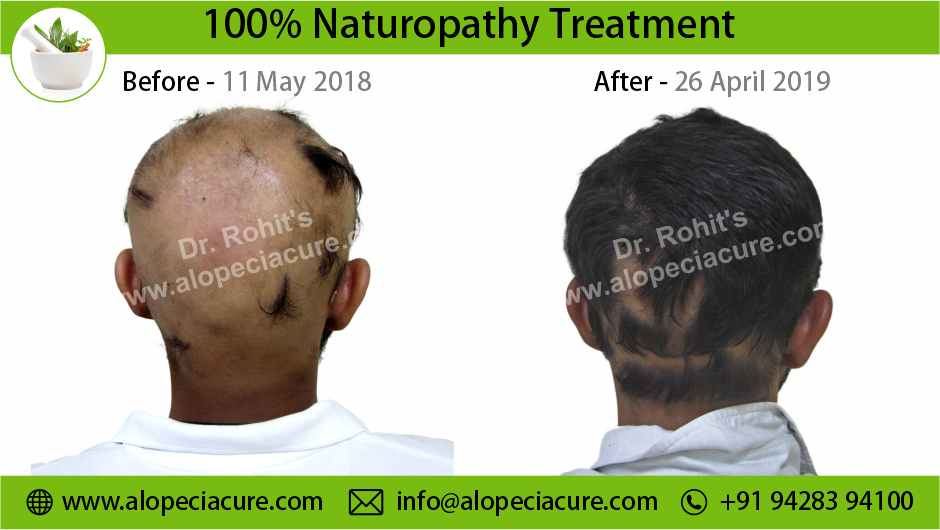 Alopecia Areata Result 5